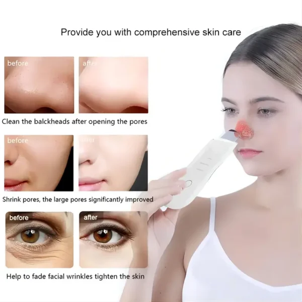 Blackhead Shovel Machine for Facial Skin Scrubber Lifting Moisturizing & Cleansing Skin Dirt Machine | Blackhead Remover Facial Cleansing Tool (White) - Image 12